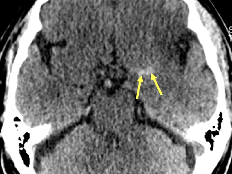Left MCA territory acute infarction in a 50-year-old man status post incomplete mechanical endoluminal thrombectomy. A. Axial noncontrast CT shows high density within the left middle cerebral artery (arrows), representing the hyperdense MCA sign.