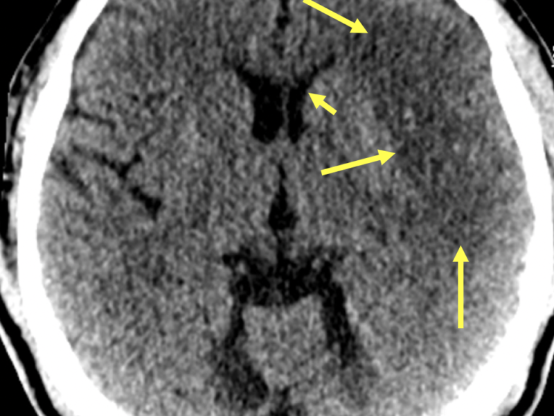 B. Axial CT superior to (A) shows low attenuation in the left frontoparietal gray matter at the interface of the white matter and sulcal effacement (long arrows), reflecting cytotoxic edema. There is also mass effect on the frontal horn of the left lateral ventricle (short arrow) without midline shift.