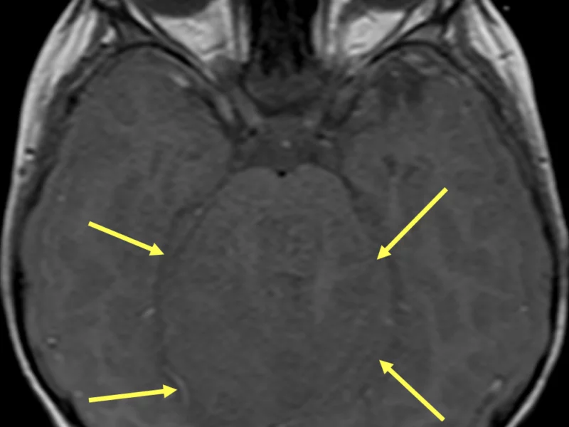 Metastatic medulloblastoma in a 2-year-old boy with altered mental status and seizure. A. Axial T1-weighted MR image shows an ill-defined mass (arrows) of mixed signal intensity.