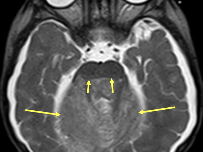 B. Axial T2 HASTE image at the same level as (A) shows the mass (long arrows) compressing the midbrain anteriorly (short arrows).