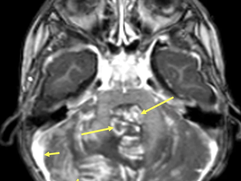 C. Axial T1 image post-contrast at a level inferior to (A) and (B) shows heterogeneous enhancement (long arrows) and a subdural fluid collection (short arrows), possibly related to ventriculostomy placement.