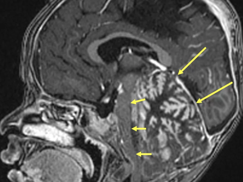 E. Sagittal T1 image post-contrast shows cerebellar enlargement, elevation of the cerebellar tentorium (long arrows) and anterior displacement of the midbrain (short arrows).