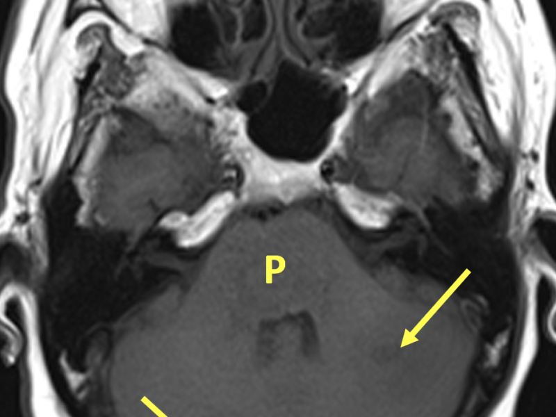 Hemorrhagic and non-hemorrhagic intraparenchymal brain metastases in a 53-year-old woman with dysphagia, altered mental status, and a history of lung cancer. A. Axial T1-weighted MR image shows heterogeneous signal in the pons (P) but no discrete lesion and two lesions within the right and left cerebellar hemispheres (arrows).  