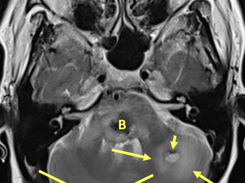 B. Axial T2 image at the same level as (A) shows a 2.7 cm mixed signal lesion within the pons. The central area of low signal represents blooming artifact (B) and signals hemorrhage. There is surrounding high signal edema. Similar appearing smaller lesions are identified within the right and left cerebellar hemispheres with rim-like blooming artifact (short arrows) and surrounding high signal edema (long arrows).