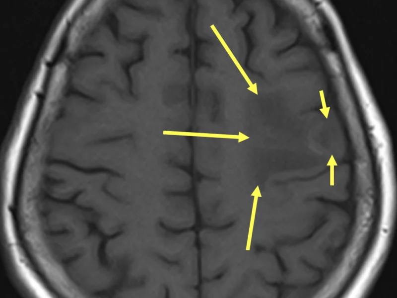D. Axial T1 image superior to (A) shows a subtle area of low signal in the peripheral left frontal lobe (short arrows) surrounded by a larger area of low signal (large arrows).