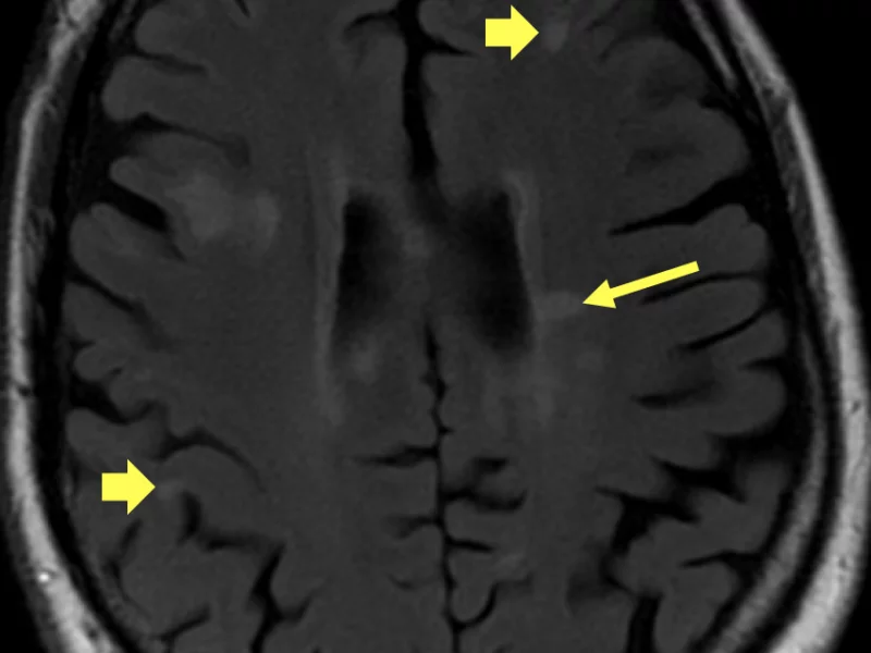 Multiple sclerosis in a 50-year-old man.   Axial T2-weighted FLAIR image shows multiple hyperintense, ovoid, fairly well-demarcated white matter lesions in a subcortical (short arrows) and periventricular (long arrow) location.  Many of the lesions were new compared with a prior MRI, thus meeting the space and time criteria for the diagnosis of MS.