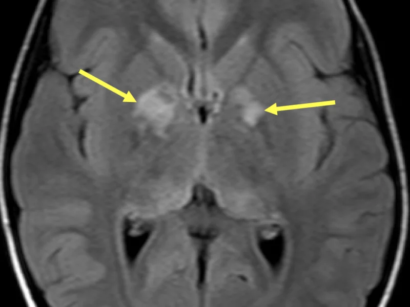 E. Axial T2 FLAIR image shows hyperintense foci (arrows) within the basal ganglia. There is no mass effect or surrounding edema.