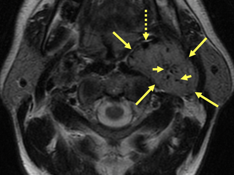 A. Axial T2-weighted MRI of a 41-year-old man with multiple paragangliomas shows a 6 cm, circumscribed, hypervascular left carotid sheath mass (long solid arrows) posterior to the left carotid bifurcation, displacing the left internal carotid artery anteromedially (dashed arrow).  The mass is separate from the left jugular foramen, consistent with a glomus vagale tumor. Note several small low signal foci (short arrows) within the mass, representing vascular flow voids and creating a “salt-and-pepper” appearance. The left internal jugular vein is compressed and not visualized.