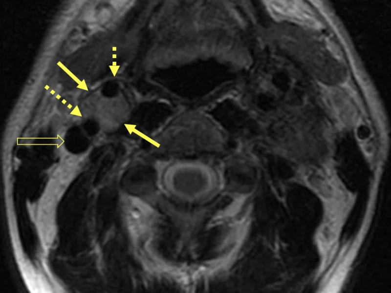 B. Axial T2-weighted MRI inferior to (A) shows a 15 mm circumscribed, hypervascular mass (long solid arrows) within the right carotid bifurcation, splaying the right internal carotid artery posterolaterally (long dashed arrow) and the right external carotid artery anteromedially (short dashed arrow) consistent with a carotid body tumor. The right internal jugular artery (open arrow) is posterior to the mass.