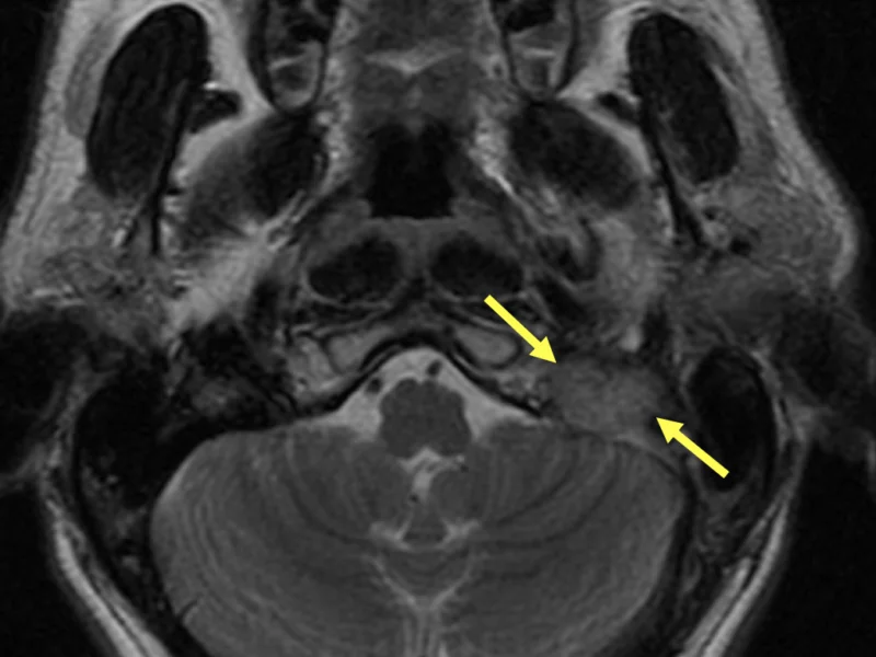 C. Axial T2-weighted MRI superior to (A) and (B) shows a 2 cm hypervascular mass (arrows) in the left jugular foramen, occluding the left jugular vein, consistent with a glomus jugulare tumor.