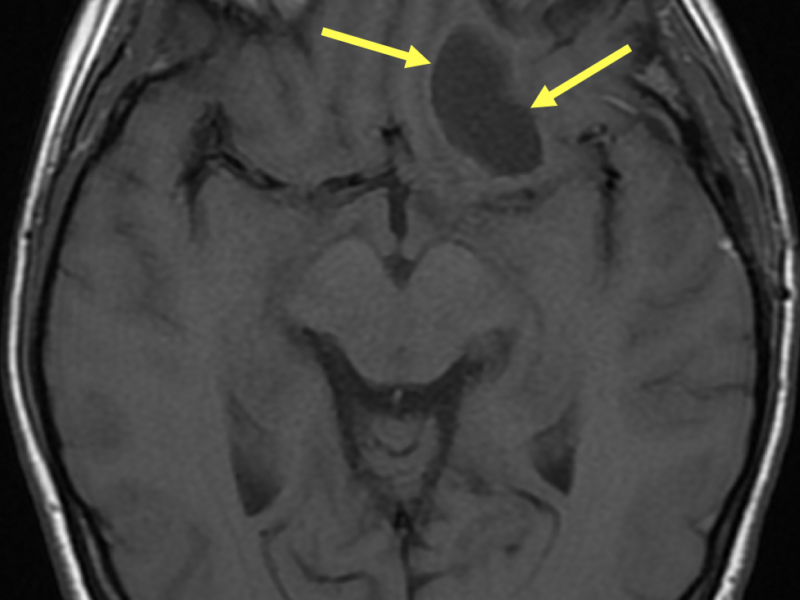 Pilocytic astrocytoma in a 23-year-old woman. A. Axial T1-weighted image shows a circumscribed 2.8 cm lobular cystic mass (arrows) of homogeneous low signal in the orbitofrontal white matter extending into the left gyrus rectus (GR).