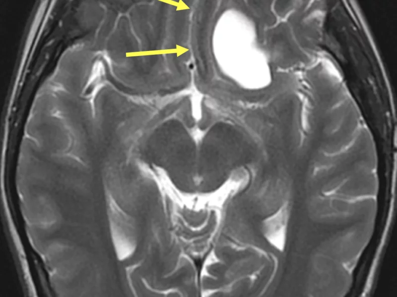 B. Axial T2 FSE image at the same level as (A) shows the cystic mass to be hyperintense and associated with mild mass effect (arrows).