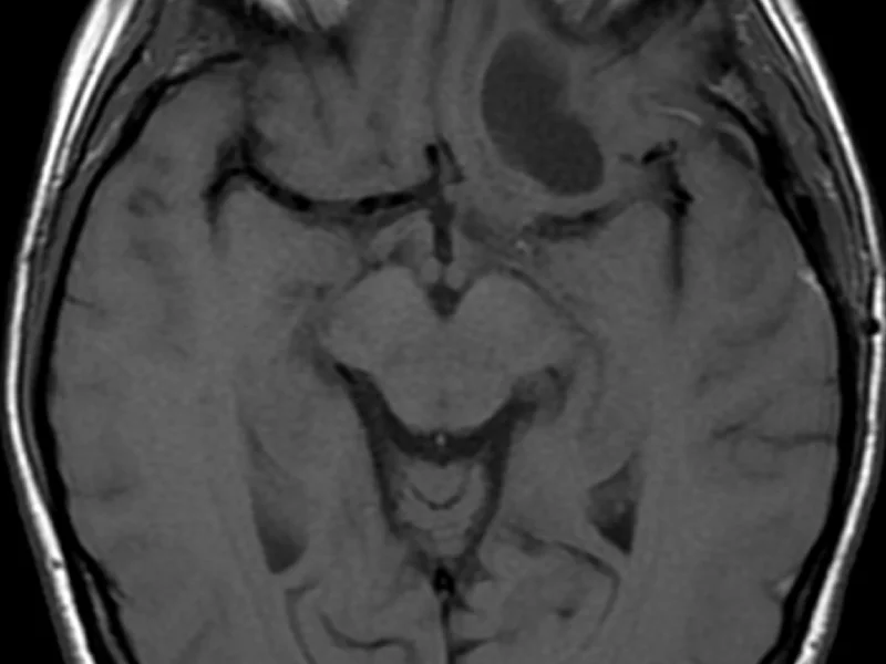 C. Axial T1 image post-contrast administration shows no enhancement of the mass (however, absence of normal enhancement elsewhere in the brain raises the question of the timing and effectiveness of the contrast examination).