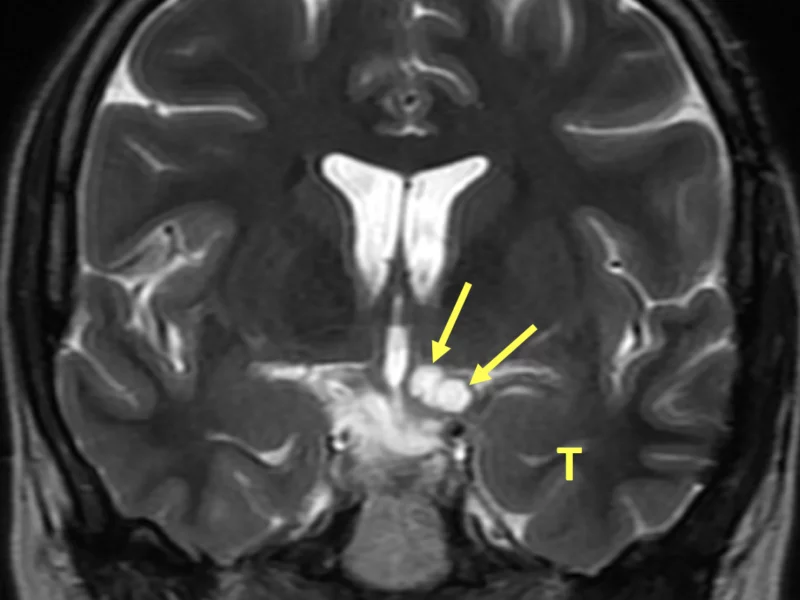 D. Coronal T2 FSE image shows multiple high signal cysts (arrows) medial to the left temporal lobe (T) at the level of the internal carotid artery bifurcation, within the left suprasellar cistern, and involving the left optic chiasm. On sagittal images, this area may be contiguous with the posteroinferior portion of the intra-axial cystic portion of the lesion (not shown).