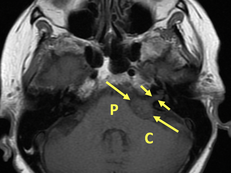 Vestibular schwannoma in a 65-year-old woman with ataxia. A. Axial T1-weighted MR image shows a 2 cm slightly hypointense left cerebellopontine angle (CPA) mass (long arrows) extending into the internal auditory canal (IAC, short arrows). P=pons, C=cerebellum.