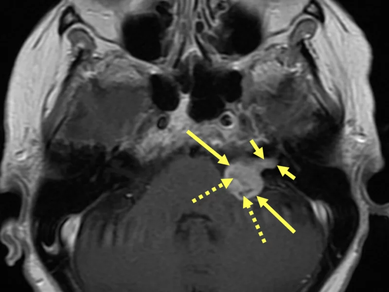 B. Axial T1 FSE with contrast at the same level as (A) shows heterogeneous avid enhancement of the CPA mass (long solid arrows) extending into the expanded IAC (short solid arrows). Hypointense areas within the mass (dashed arrows) may represent cystic foci. The vestibulocochlear (8th) nerve which is comprised of the 1) vestibular nerve (controls balance) and the 2) cochlear nerve (transmits sound) travels through the IAC.