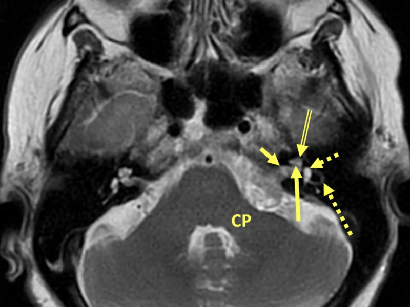 C. Axial T2 with contrast at the same level as (A) shows the left CPA mass extending into the IAC (short arrow) to the cochlear aperture (long arrow), which leads to the cochlea (divided arrow). The cochlear vestibule (short dashed arrow) and semicircular canals (long dashed arrow) are lateral and posterior to the cochlea. There is mass effect on the middle cerebellar peduncle (CP).