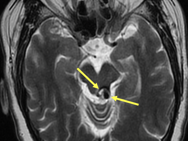 62-year-old man with a cavernous malformation. Axial T1 FSE (A), Axial T2 (B), and Sagittal T1 FLAIR (C) images show a 1.2 cm mass (arrows) with a reticulated pattern of mixed signal intensity (so-called “popcorn” or “mulberry” appearance due to multiple episodes of hemorrhage), with a hypointense rim of hemosiderin. The mass is exophytic and centered slightly to the left of midline at the level of the left superior colliculus of the midbrain extending inferiorly to the superior medullary velum. No acute hemorrhage is identified.
