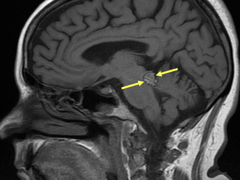 62-year-old man with a cavernous malformation. Axial T1 FSE (A), Axial T2 (B), and Sagittal T1 FLAIR (C) images show a 1.2 cm mass (arrows) with a reticulated pattern of mixed signal intensity (so-called “popcorn” or “mulberry” appearance due to multiple episodes of hemorrhage), with a hypointense rim of hemosiderin. The mass is exophytic and centered slightly to the left of midline at the level of the left superior colliculus of the midbrain extending inferiorly to the superior medullary velum. No acute hemorrhage is identified.