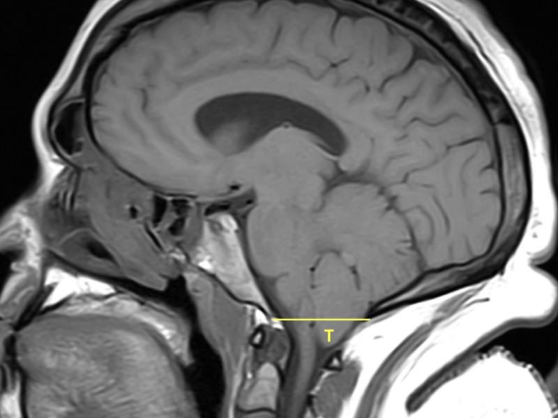 Chiari I malformation in a 29-year-old woman with headaches and neck pain. Sagittal T1 FSE image shows “pegging” of the displaced cerebellar tonsils (T), which extend 8 mm below the foramen magnum (yellow line). No upper cervical syrinx is seen.