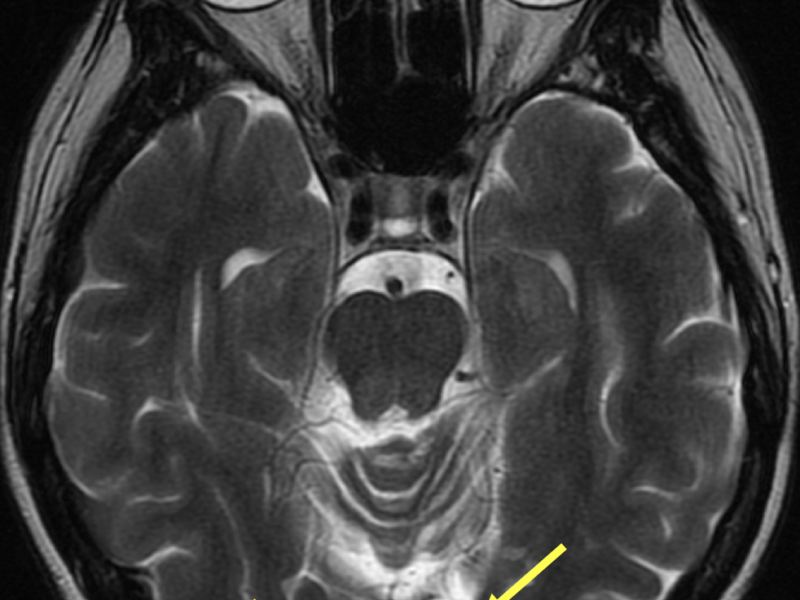 Encephalomalacia in a 36-year-old woman with a history of stroke and nystagmus in the right eye. A. Axial T2-weighted MR image shows volume loss and high signal (arrows) in the occipital lobes, left greater than right.