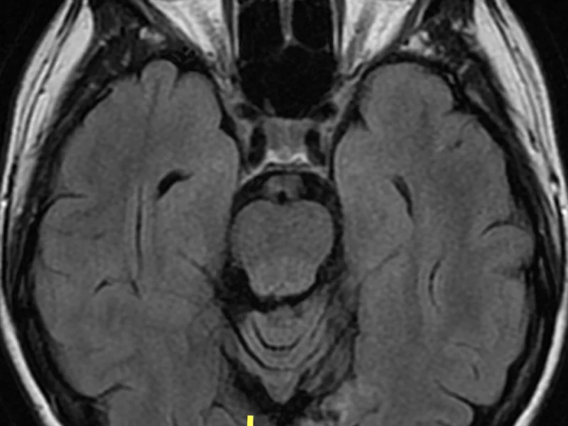 B. Axial T2 FLAIR image at the same level as (A) shows the areas of encephalomalacia (E) to be the same low signal as that of cerebral spinal fluid, and surrounding gliosis (arrows) to be high signal.