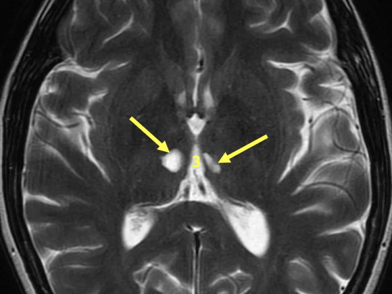 C. Axial T2 image at the level of the third ventricle (3) shows areas of high signal (arrows) in the thalami bilaterally.