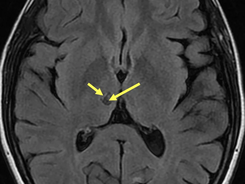 D. Axial T2 FLAIR image at the same level as (C) shows the encephalomalacia in the right thalamus to be low signal (long arrow) and the surrounding gliosis to be high signal (short arrow).