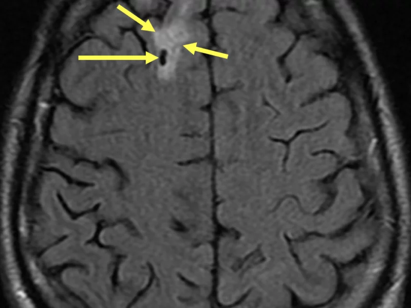 B. Axial T2 FLAIR image at a level superior to (A) shows a low signal area of susceptibility artifact (long arrow) surrounded by high signal edema (short arrows) in the right frontal lobe.