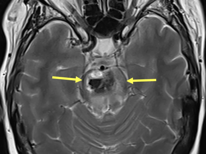 Multiple hemorrhagic metastases in a 53-year-old female with dysphagia, altered mental status, and a history of lung and spine cancer. A. Axial T2-weighted MRI shows a 2.7 cm mixed signal lesion within the pons (arrows) with a moderate amount of surrounding edema.