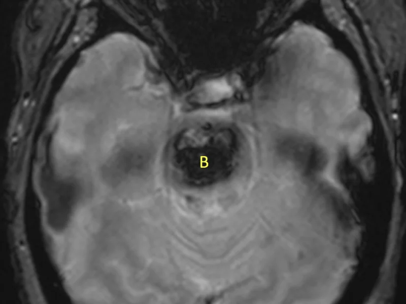B. Axial gradient echo image at the same level as (A) shows a large area of low signal blooming artifact (B) in the pons, consistent with prior hemorrhage and hemosiderin.