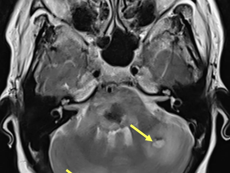 C. Axial T2-weighted image at a level inferior to (A) and (B) shows two high signal hemorrhagic lesions within the cerebellum (arrows).  Each has a low signal rim consistent with hemosiderin and both exhibit marked surrounding high signal edema.
