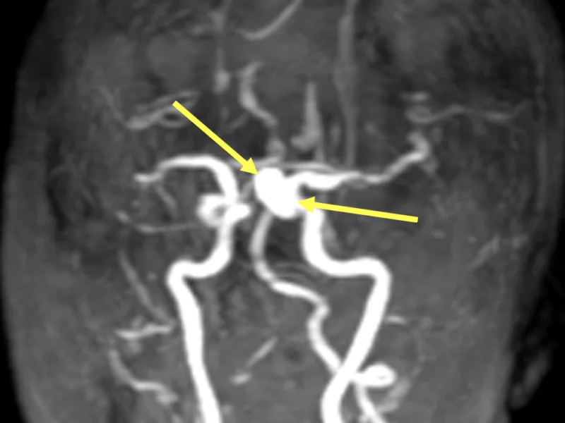 Saccular intracranial aneurysm (IA) in a 71-year-old woman. A. MRA after dynamic contrast administration shows a saccular aneurysm arising from the distal left internal carotid artery (arrows)
