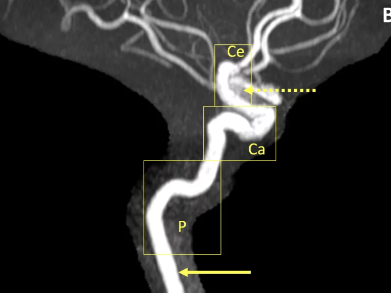 B. MRA shows the approximate locations of the segments of the left internal carotid artery in profile: cervical (solid arrow), petrous (P), cavernous (Ca), and cerebral (Ce). The IA (dashed arrow) is partially obscured.