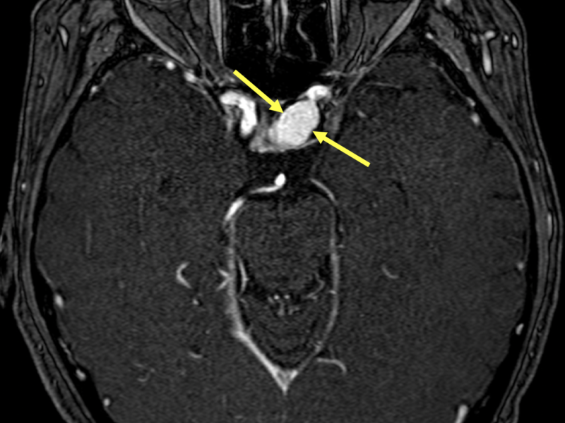 D. Axial MRI with contrast shows homogeneous enhancement of the IA (arrows) without evidence of thrombus. The aneurysm prolapses into the cavernous sinus as well as into the sella turcica.   