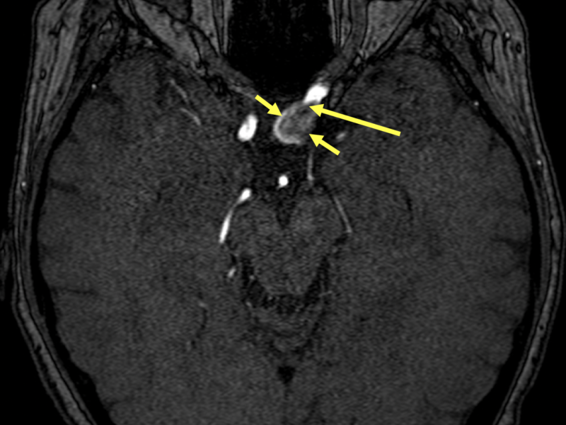 C. Axial MR image pre-contrast shows a saccular IA (short arrows) measuring 1.6 x 1.2 x 1.75 cm. The neck (long arrow) is 3 mm in width. 
