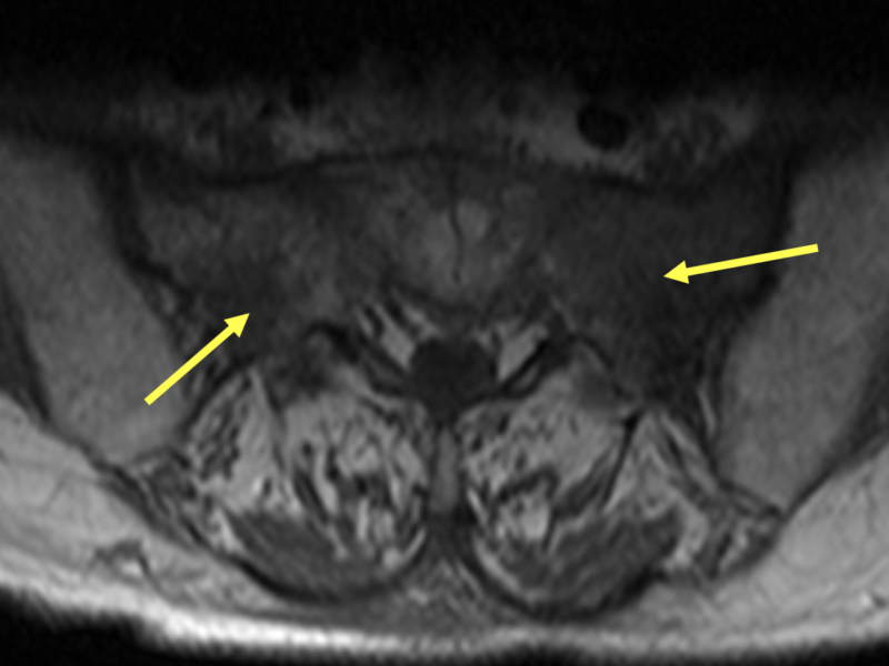 B. Axial T1 MR image shows hypointense areas in the sacrum bilaterally (arrows), left greater than right, consistent with edema.