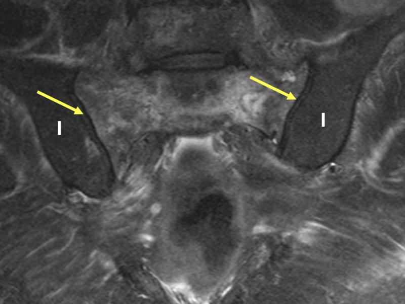 C. Coronal T2 FS MR image shows mottled areas of hyperintense signal throughout the sacrum. Note normal signal within the iliac bones (I) for comparison. The sacroiliac joints are normal (arrows).