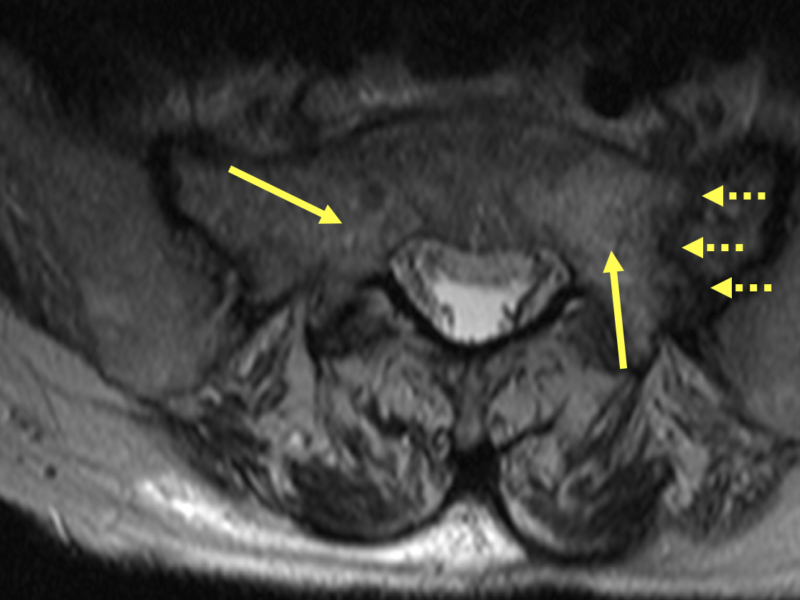 Bilateral sacral insufficiency fractures in a 78-year-old woman with 2.5 weeks of pain in both buttocks that radiates into the right leg. A. Axial T2 MR image shows hyperintense edema throughout all sacral zones bilaterally (solid arrows), left greater than right. There is a vertical hypointense fracture line within the area of edema on the left (dashed arrows).