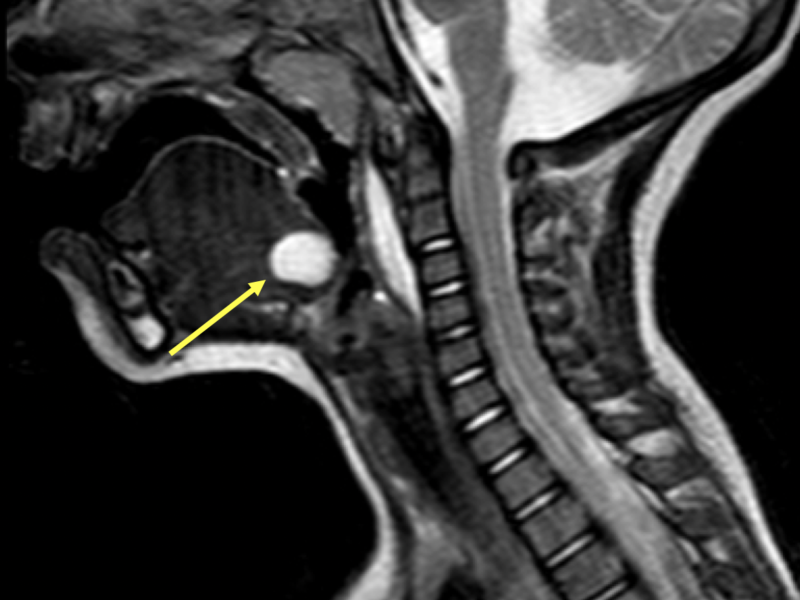 Thyroglossal duct cyst in a 1-year-old boy. A. Sagittal T2 SE midline MR image demonstrates a hyperintense, cystic lesion at the base of the tongue (arrow), which corresponds to the foramen cecum, the embryological origin of the thyroid tissue. Prevertebral high signal is related to a lymphatic malformation.  