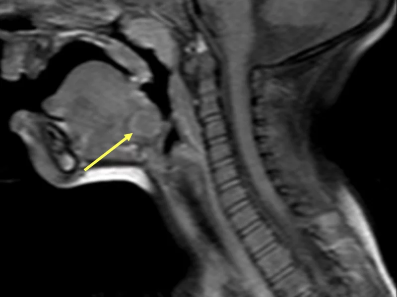 C. Sagittal T1 SE FS post-contrast image at the same level as (A) and (B) confirms the cystic nature of the base-of-tongue lesion (arrow), which does not enhance centrally.   