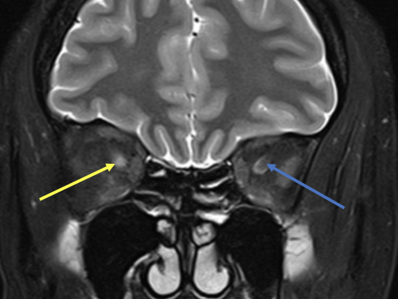Optic neuritis. A. Coronal T2 FS MR image through the level of the optic nerves shows abnormal high signal edema involving the right optic nerve (yellow arrow), and a normal low signal left optic nerve (blue arrow) surrounded by a small amount of high signal CSF in the optic nerve sheath.  