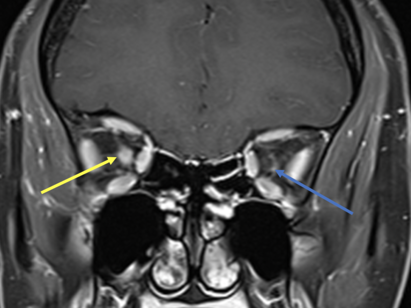 B. Coronal T1 post-contrast FS image at the same level as (A) shows abnormal enhancement of the right optic nerve (yellow arrow) and normal thin peripheral enhancement of the left nerve sheath (blue arrow).