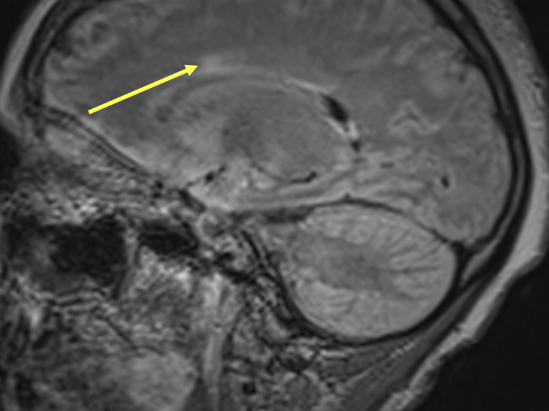 C. Sagittal T2 FLAIR image of the brain demonstrates perivenular hyperintensity (arrow) arising perpendicular to the corpus callosum, which is a common finding in multiple sclerosis.