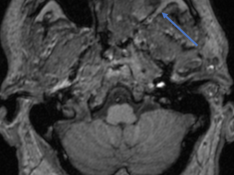 Inverted papilloma in a 73-year-old male with an intranasal mass on physical examination. A. Axial T1 pre-contrast MR image at the level of the maxillary sinuses shows heterogeneous signal within the left maxillary sinus (yellow arrow) and left nasal cavity, without expansion or invasion of the retromaxillary fat (blue arrow).   