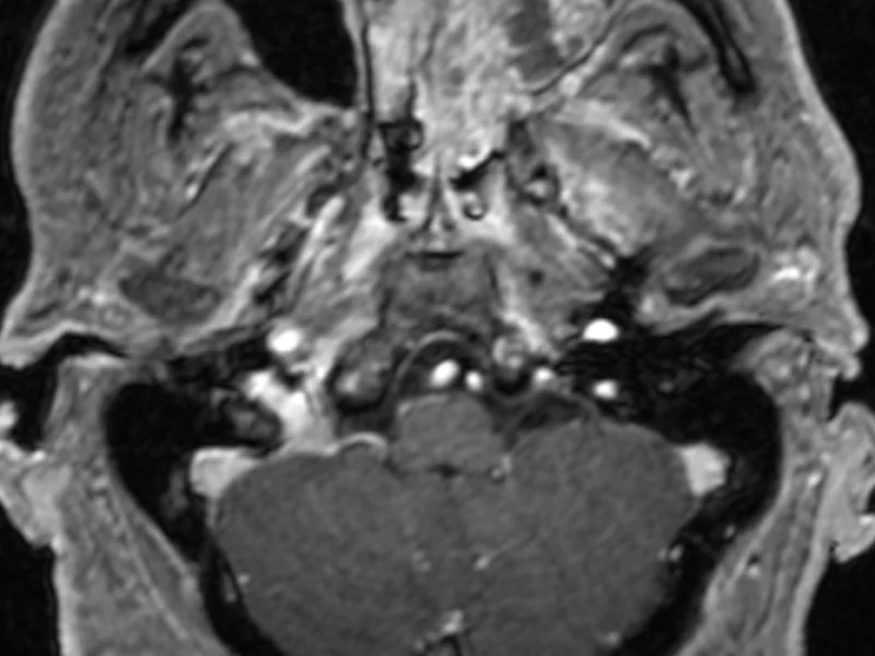 B. Axial T1 post-contrast image at the same level as (A) shows heterogeneous enhancement of the left maxillary sinus (arrow) and nasal cavity, confirming a solid mass. Differential considerations include an inverted papilloma, inflammatory polyp or antrochoanal polyp.   