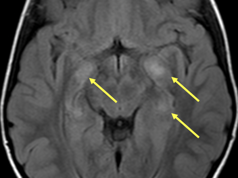 Imaging of multiple children with history of Neurofibromatosis, Type 1 A. Axial T2 FLAIR MR image demonstrates multiple hyperintensities of the unci and periventricular white matter (arrows). There are additional areas of FLAIR hyperintensities involving the basal ganglia (not shown). None of these areas demonstrate enhancement (not shown), compatible with Foci of Abnormal Signal Intensity (FASI) which is due to myelin vacuolization, not masses. These resolve during the second decade of life.