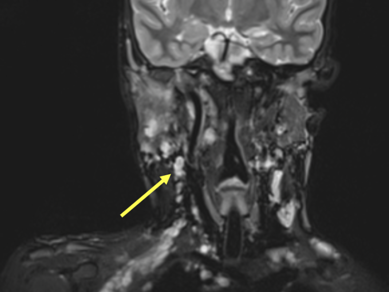 C. Coronal T2 FS image of the head/neck demonstrating numerous fusiform T2 hyperintensities along the nerve roots and brachial plexus (arrows), corresponding to plexiform neurofibromas.   