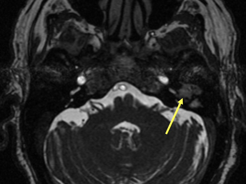Cholesteatoma in a 70-year-old male with pulsatile tinnitus. A. Axial thin-slice fluid sensitive MR image shows bright signal in the left middle ear (arrow) and mastoid, which alone is nonspecific and could represent an effusion, inflammation, or a cholesteatoma.   