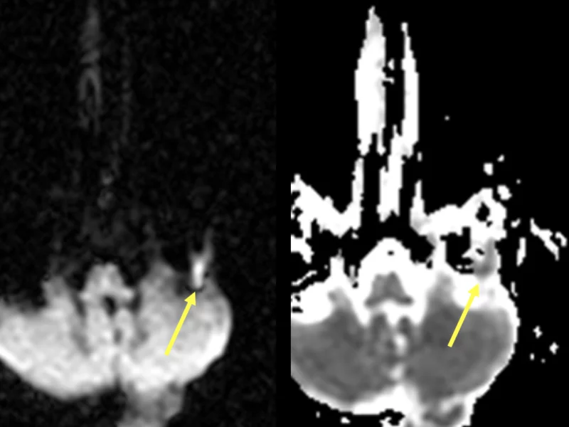D and E. Axial DWI image shows increased signal in the left mastoid and middle ear (D, arrow), corresponding to low signal on the ADC map (E, arrow), representing restricted diffusion. These are key findings of a cholesteatoma.   